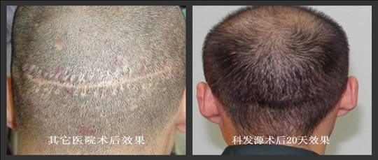 科發(fā)源第四屆交流會(huì)新亮點(diǎn)：FUT術(shù)后條狀變線痕